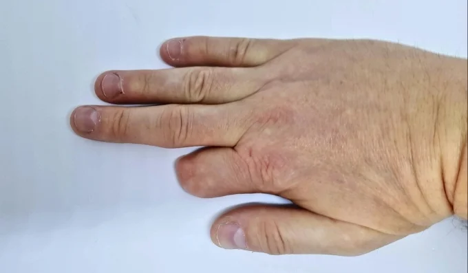 Mão com dedo amputado após acidente de trabalho, indicando a questão da indenização